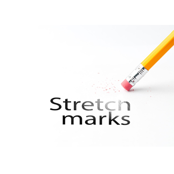 Cara Mudah Menyamarkan Strech Marks