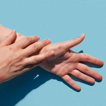 8 Rekomendasi IDI untuk Pencegahan Monkeypox 