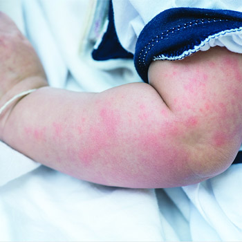 Kulit Bayi Bengkak dan Kemerahan, Mungkinkah Terkena Selulitis?