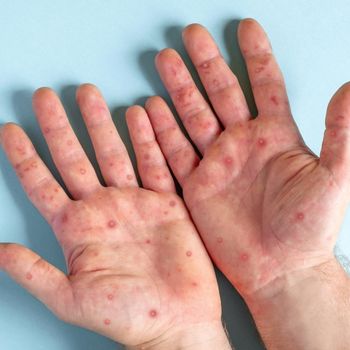 Monkeypox Update: Kasus Pertama dari Jakarta