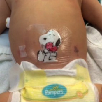 Gambar Kartun di Bekas Jahitan, Bantu Anak Tak Takut Operasi