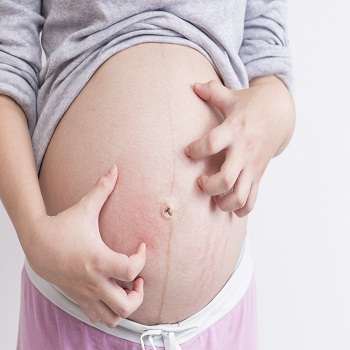 Warisan Stretch Mark 