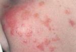 Apa Itu Roseola infantum? 