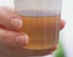 Apa Itu Glycosuria?