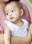 Jerawat di Wajah Bayi